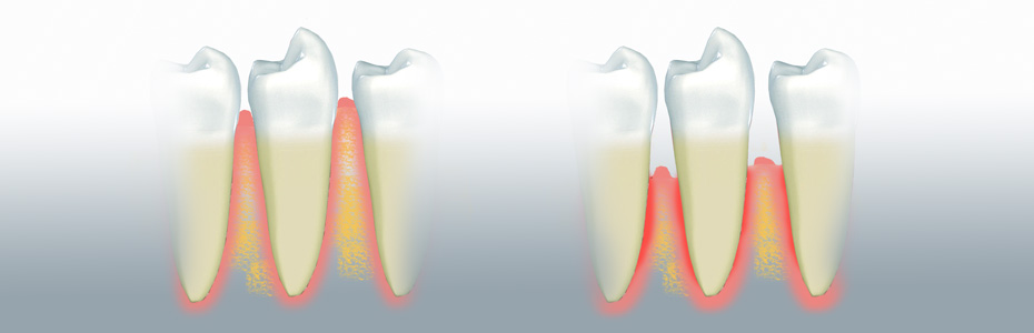 Schonende Parodontalbehandlungen